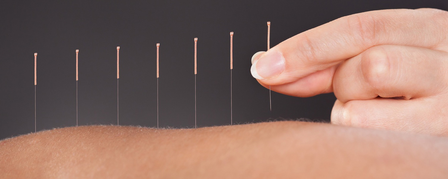 Acupuncture needles being inserted into patient.