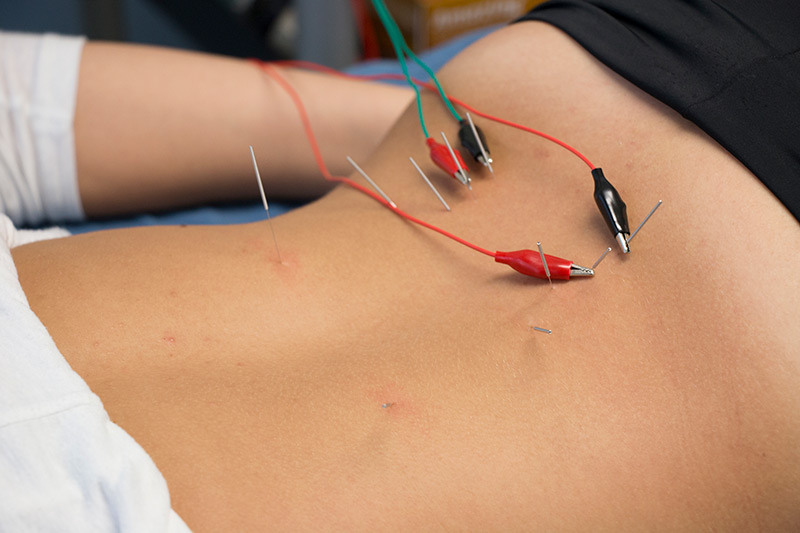 Dry needle treatment being administered to lower back.