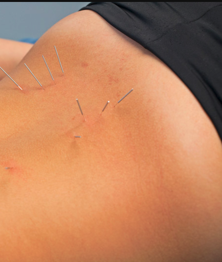Dry needle acupuncture for hip pain being applied to a patient.