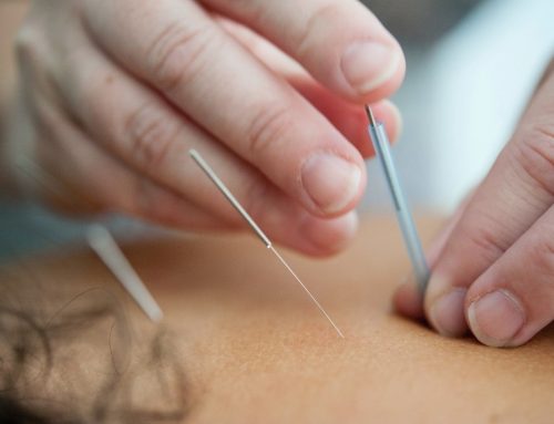 What Not to Do after a Dry Needle Treatment