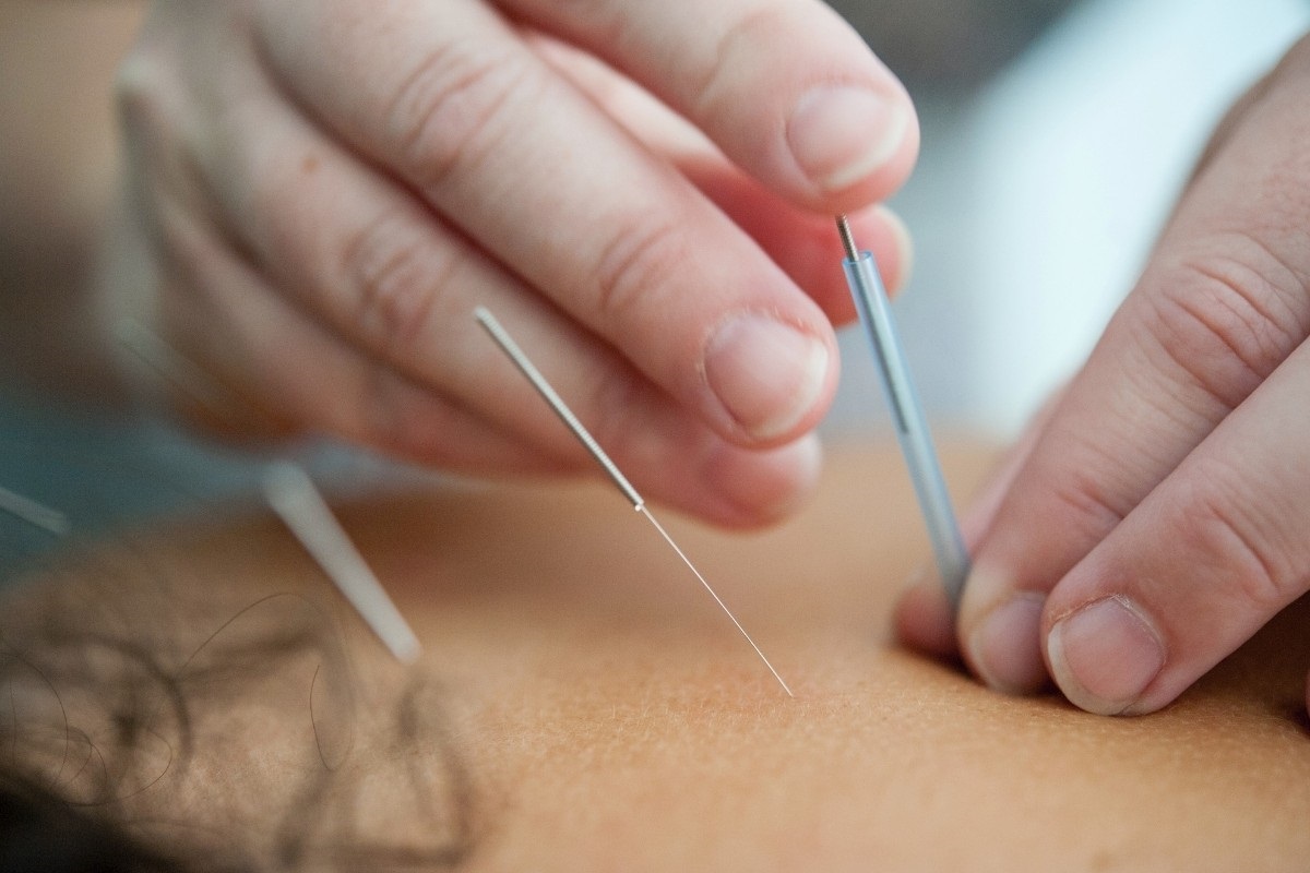 What Not to Do after a Dry Needle Treatment